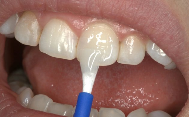 Fluoride Application